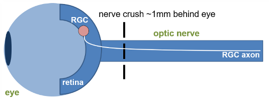 Nerve Crush Illustration